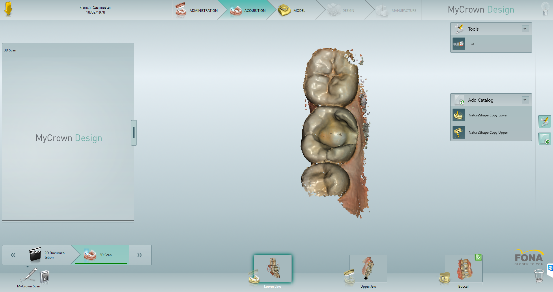 Removal of leaking amalgam restorations and placement of ceramic CAD ...