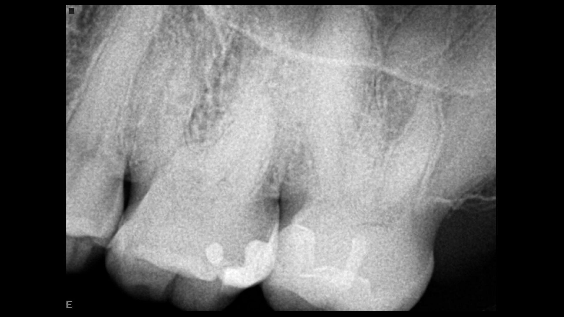 Fig. 1: Pre-op radiograph, showing a very complex root canal system and a calcified pulp chamber.